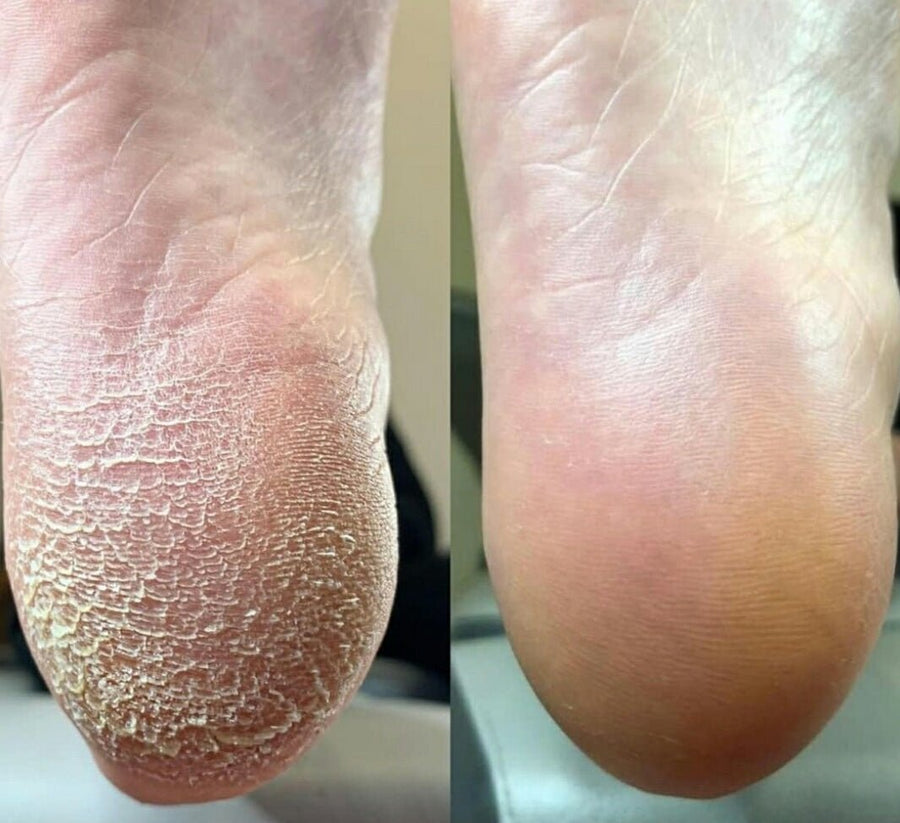 Foot Cream 15% Urea - BYŪTI